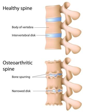 Osteoarthritic Spine Anatomy Diagram